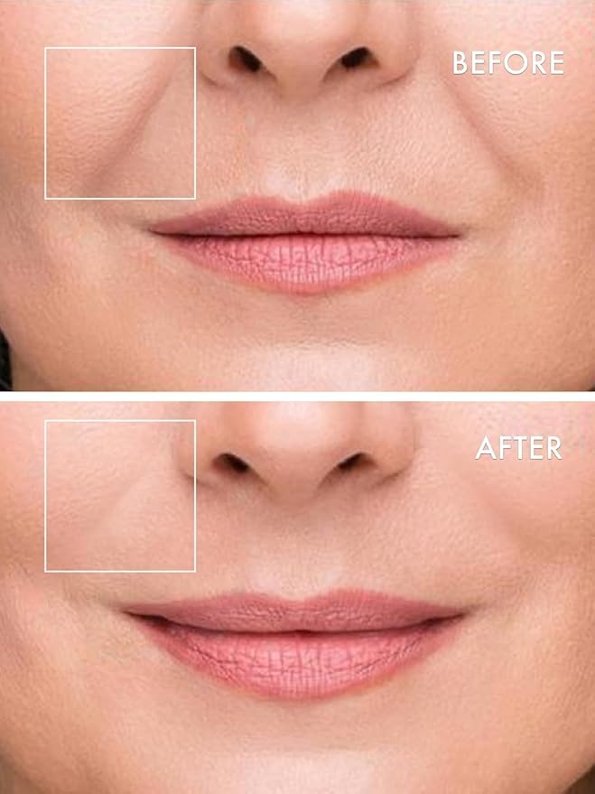 Microneedle Undereye Patches®