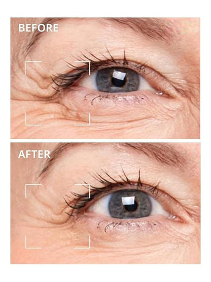 Microneedle Undereye Patches®